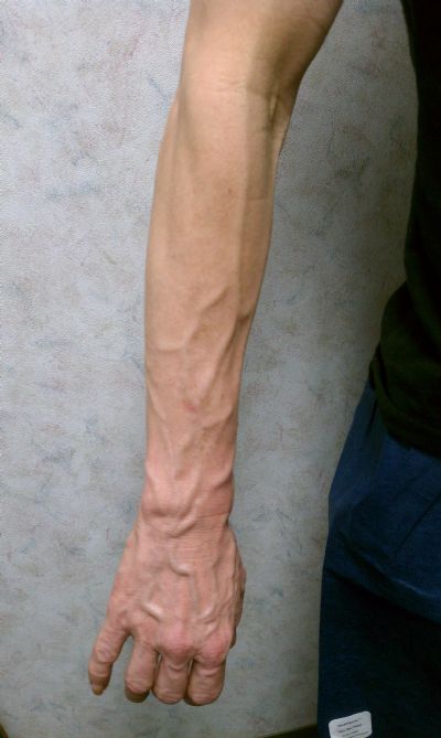 what-is-varicose-veins-how-its-occur-varicose-veins-my-xxx-hot-girl