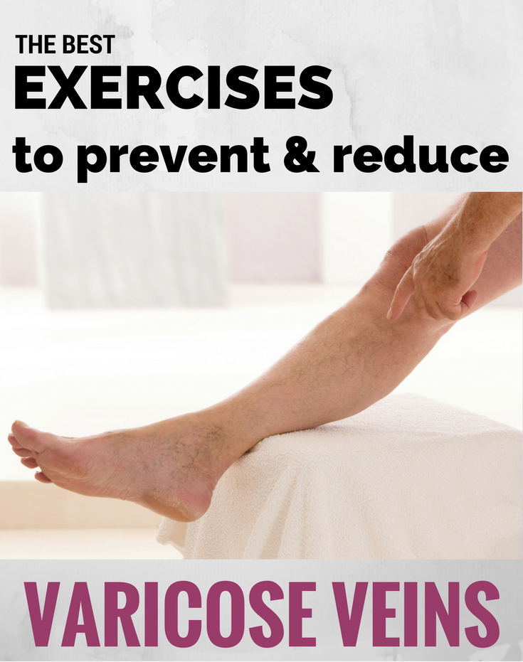 The Best Exercises For Varicose Veins Top Varicose Vein Treatment Nyc