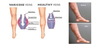 Varicose Veins Surgery