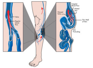 Five Things You Should Know about Ambulatory Phlebectomy