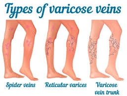 recular varicoza