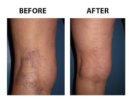 spider-varicose-vein-treatment-before-after-vein-gogh-03