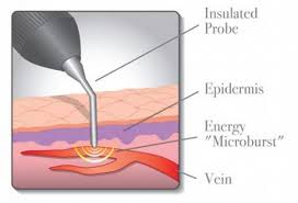 vein-gogh-treatment-nyc-vascular-specialist-01