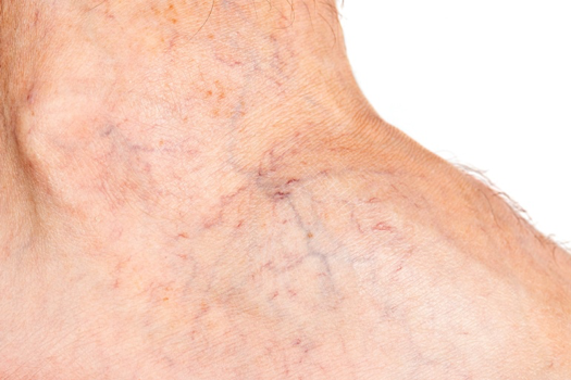 Causes of spider veins