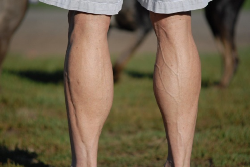 Treatment and causes of spider veins