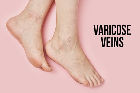 Main Causes of Varicose Veins