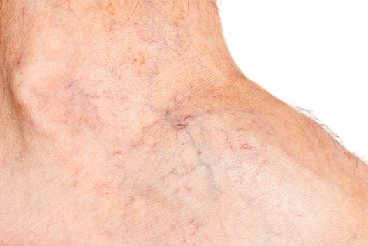 Spider Vein Treatments NYC