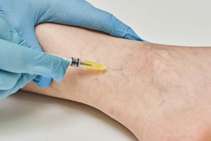 Spider Vein Treatments Sclerotherapy NYC