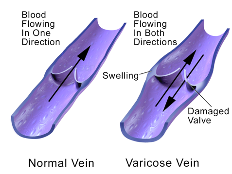 Varicose Veins and Treatment Options