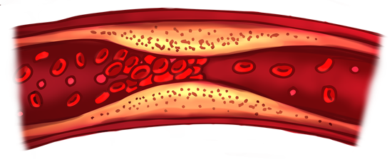 Best Vascular Surgeon for Blood Clots DVT