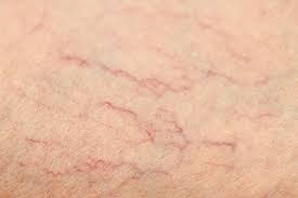 Spider Veins Causes Treatment Prevention