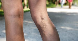 varicose veins causes symptoms treatment options