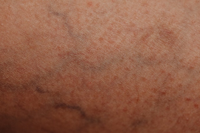 Best Radiofrequency Ablation vein treatment