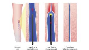 Radiofrequency Ablation RFA for vein treatment NYC