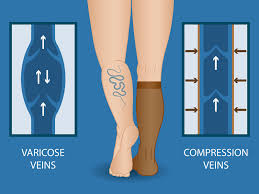 compression-stockings-for leg vein issues