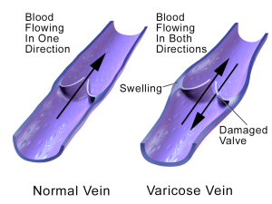 prevention tips 
pregnancy and varicose veins