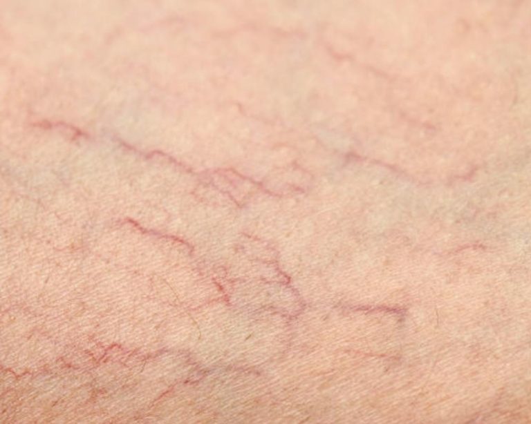 The Benefits of Sclerotherapy for Spider Veins What to Expect Top Varicose Vein Treatment NYC